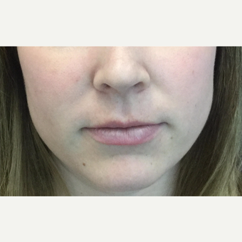 25-34 year old woman treated with Lip Augmentation before 3583520