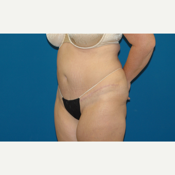 52 year old woman treated with Tummy Tuck after 3283041