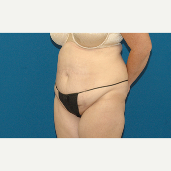 52 year old woman treated with Tummy Tuck before 3283041