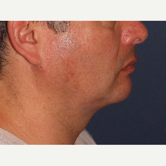35-44 year old man treated with ThermiTight after 3138904