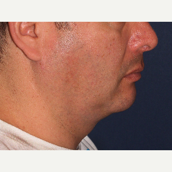 35-44 year old man treated with ThermiTight before 3138904