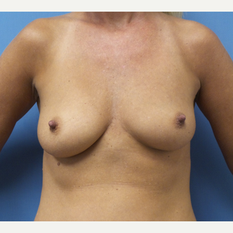 35-44 year old woman treated with Breast Augmentation before 3685227