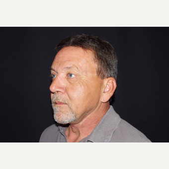 55-64 year old man treated with Direct Neck Lift after 3439248