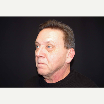 55-64 year old man treated with Direct Neck Lift before 3439248