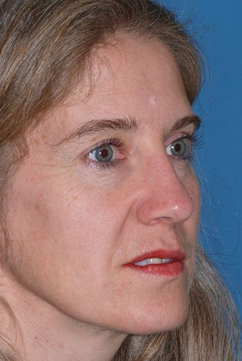 Rhinoplasty after 81093