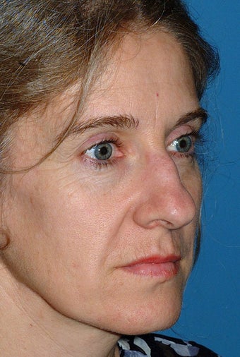 Rhinoplasty before 81093