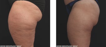 Radiofrequency with micro-needle array is very effective for skin tightening and cellulite improvement on the thighs. before 1489704