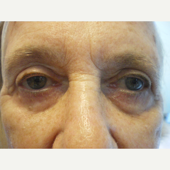 75 and up year old woman treated with Restylane before 3060119