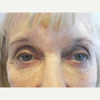 75 and up year old woman treated with Restylane after 3060119
