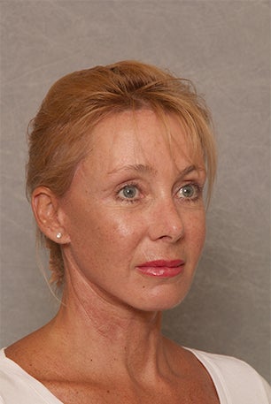Neck Lift after 1392512