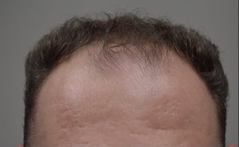 35-44 year old man treated with FUE Hair Transplant before 3550910