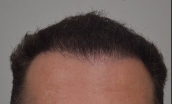 35-44 year old man treated with FUE Hair Transplant after 3550910