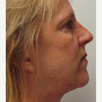 Face IPL treatment for Sun Damage for this 57 Year Old Woman after 3104680