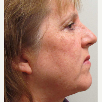 Face IPL treatment for Sun Damage for this 57 Year Old Woman before 3104680