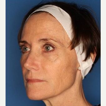 55-64 year old woman treated with Sculptra before 3711834
