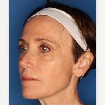 55-64 year old woman treated with Sculptra after 3711834