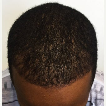 35-44 year old man treated with ARTAS Robotic Hair Transplant after 2106230