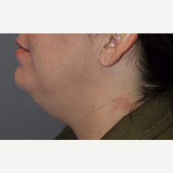 35-44 year old woman treated with Kybella before 3147376