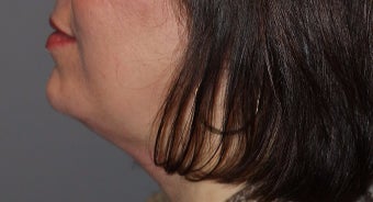 35-44 year old woman treated with Kybella after 3147376
