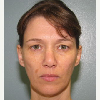 45-54 year old woman treated with Bellafill before 3143405
