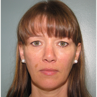 45-54 year old woman treated with Bellafill after 3143405
