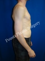Breast Enhancement, Gender Reassignment, Silicone gel Implants 1516375