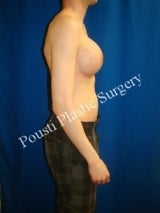 Breast Enhancement, Gender Reassignment, Silicone gel Implants 1516375