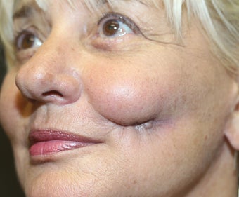 Procedure: Scar Revision 1496674