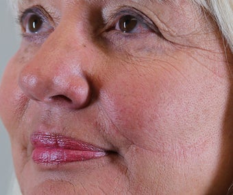 Procedure: Scar Revision 1496674