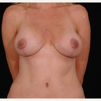 35-44 year old woman treated with Breast Lift with Implants after 3052682