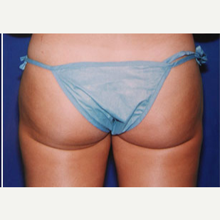 25-34 year old woman treated with Liposuction after 3646240