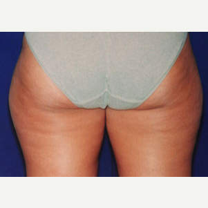 25-34 year old woman treated with Liposuction before 3646240