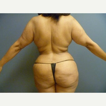 45-54 year old woman treated with Brazilian Butt Lift after 1605525