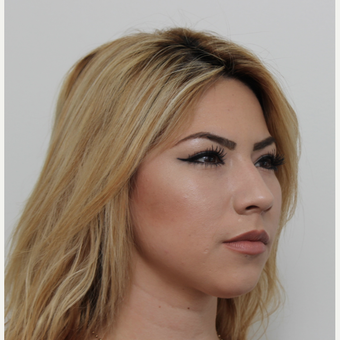 18-24 year old woman treated with Rhinoplasty before 3371526