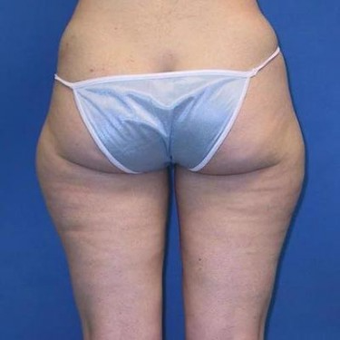 25-34 year old woman treated with Liposuction before 3496826