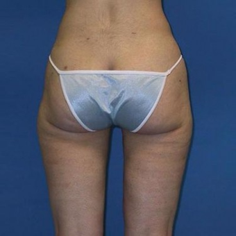 25-34 year old woman treated with Liposuction after 3496826