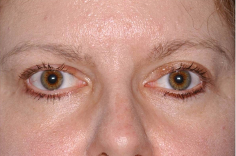 Thyroid Eye Disease Eyelid retraction after 640816