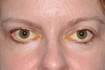 Thyroid Eye Disease Eyelid retraction before 640816