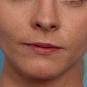 25-34 year old woman treated with Lip Augmentation before 3577758