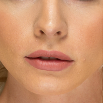 25-34 year old woman treated with Lip Augmentation after 3577758