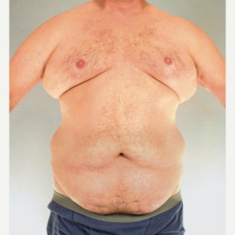45-54 year old man treated with Tummy Tuck before 1661849