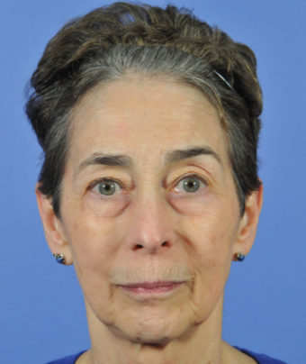 55-64 year old woman treated with Ultherapy before 1832312