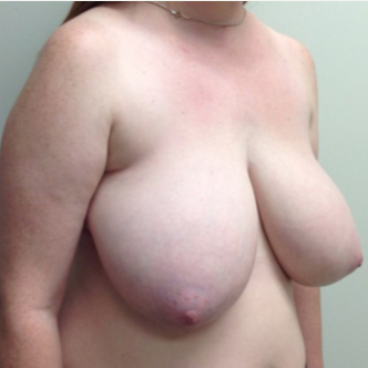Breast Reduction for this 26 Year Old Woman before 3030440