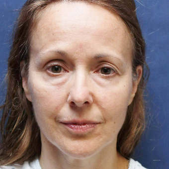 Lower Facelift for Jowls and Bellafill for Lower Eyelid Bags and Lip Lines in a 54 Year Old before 3775231