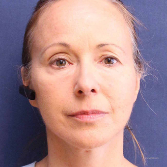 Lower Facelift for Jowls and Bellafill for Lower Eyelid Bags and Lip Lines in a 54 Year Old after 3775231