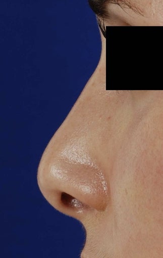 25-34 year old woman treated with Revision Rhinoplasty before 1750775