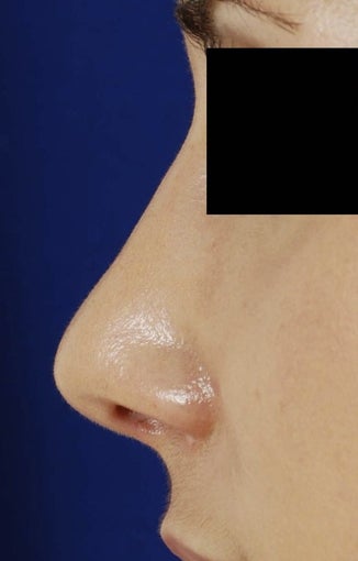 25-34 year old woman treated with Revision Rhinoplasty after 1750775
