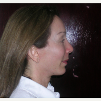 45-54 year old woman treated with Facelift and Rhinoplasty after 3737952