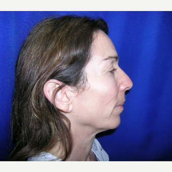 45-54 year old woman treated with Facelift and Rhinoplasty before 3737952