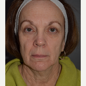 Pre and Post-OP photos of Phenol Croton Oil Peel and Lower Facelift with Submentoplasty before 3108164